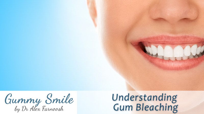 Understanding Gum Bleaching